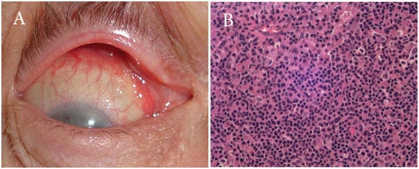 lymphoma